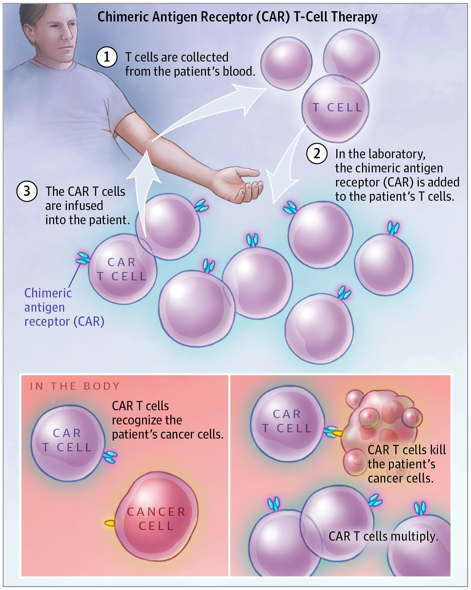 Chimeric Antigen Receptor Car T Cell Therapy Jama Oncology X Mol