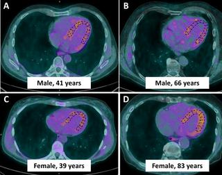 Age And Sex Dependent Changes In Sympathetic Activity Of The Left