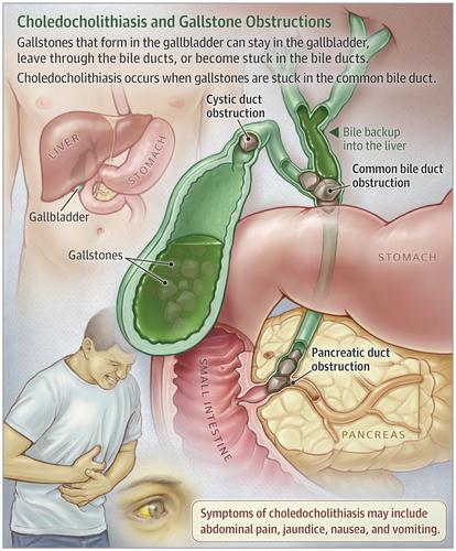 goes from the gallbladder to the large bile duct ( cystic duct)