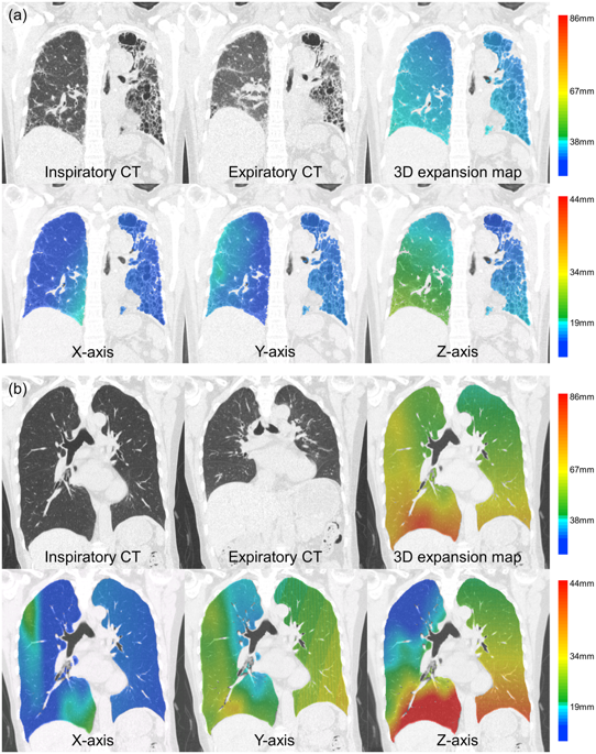 inspiratory lung expansion in patients with interstitial lung