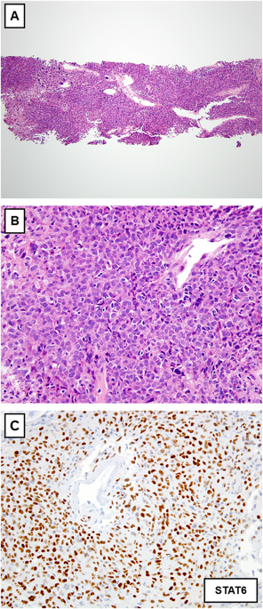 Limited Biopsies Of Soft Tissue Tumors The Contemporary Role Of