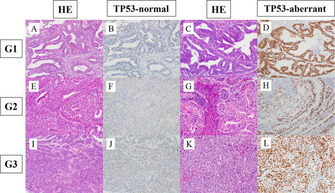 Impact Of Tp Immunohistochemistry On The Histological Grading System