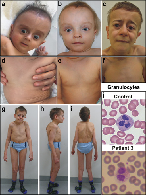 SOPH Syndrome In Three Affected Individuals Showing Similarities With