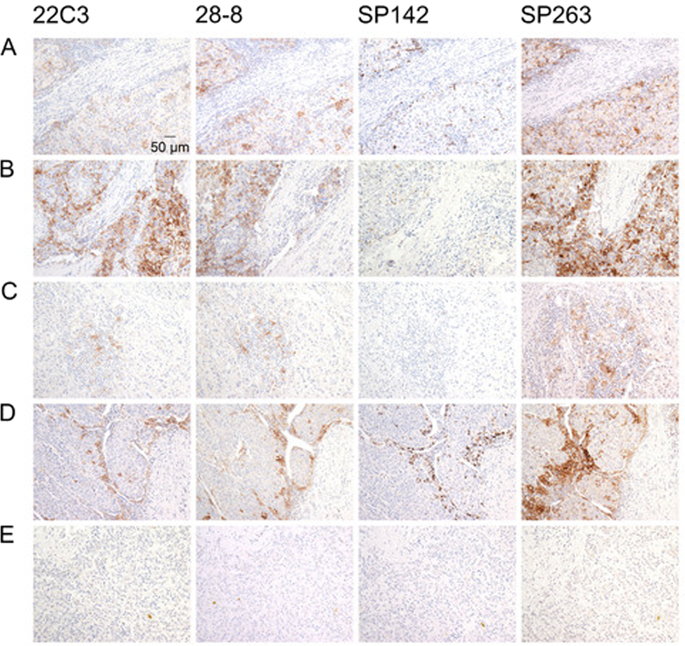 肝细胞癌中 PD L1 表达的免疫组织化学检测的可比性研究 Modern Pathology X MOL