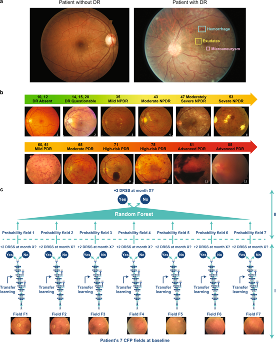 Deep Learning Algorithm Predicts Diabetic Retinopathy Progression In