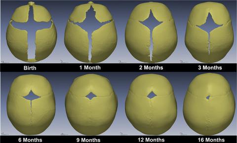 Temporal Mapping Of The Closure Of The Anterior Fontanelle And