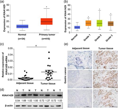 KIAA1429 Regulates Cell Proliferation By Targeting C Jun Messenger RNA