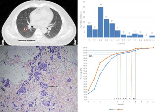 A Clinicopathologic Analysis Of Microscopic Extension In Small Cell