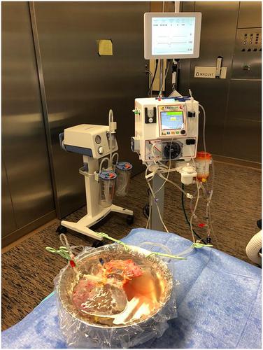 Hypothermic Oxygenated Machine Perfusion For Extended Criteria Donor