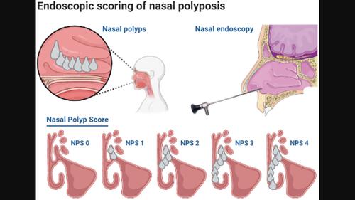 Nasal Polyps Type