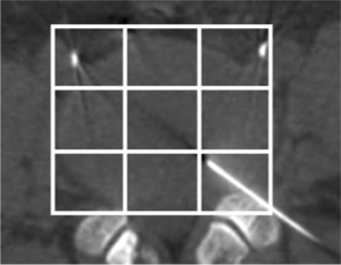 Short Term Clinical And Radiographic Outcomes Of Chemonucleolysis With