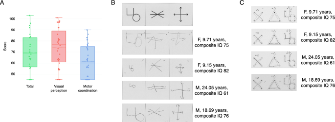 Visual Motor Integration Deficits In Q Deletion Syndrome Journal Of