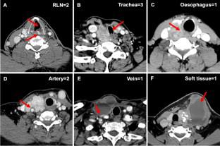 Using A Ct Based Scale To Evaluate Disease Extension And The