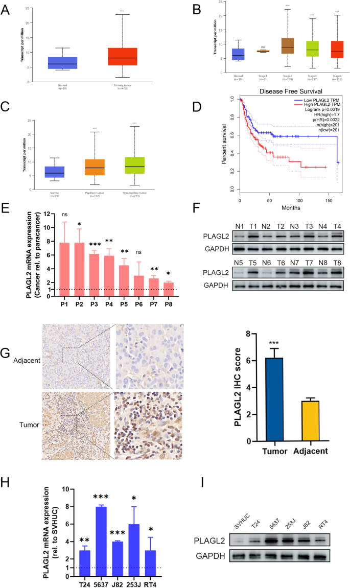 Plagl Promotes Bladder Cancer Progression Via Racgap Rhoa Gtpase Yap