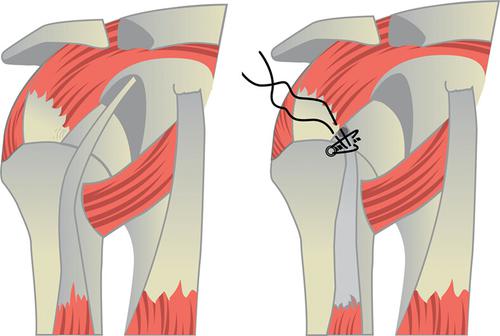 Partial Articular Supraspinatus Tendon Avulsion Repair And Patch A