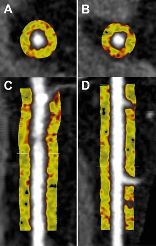 Pericoronary Adipose Tissue Attenuation On Coronary Computed Tomography