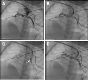 Stent Strut Dilation In Branch Pulmonary Artery Stenosis Following