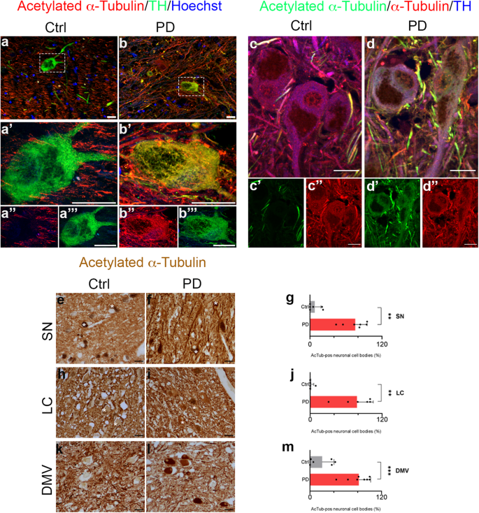 Linking acetylated α Tubulin redistribution to α Synuclein pathology in