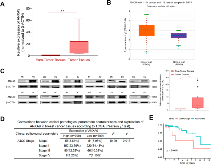 ANXA9 Facilitates S100A4 And Promotes Breast Cancer Progression Through