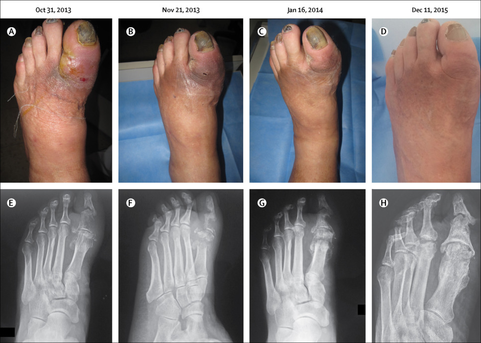 Non Surgical Treatment Of Diabetic Foot Osteomyelitis The Lancet Diabetes And Endocrinology X Mol