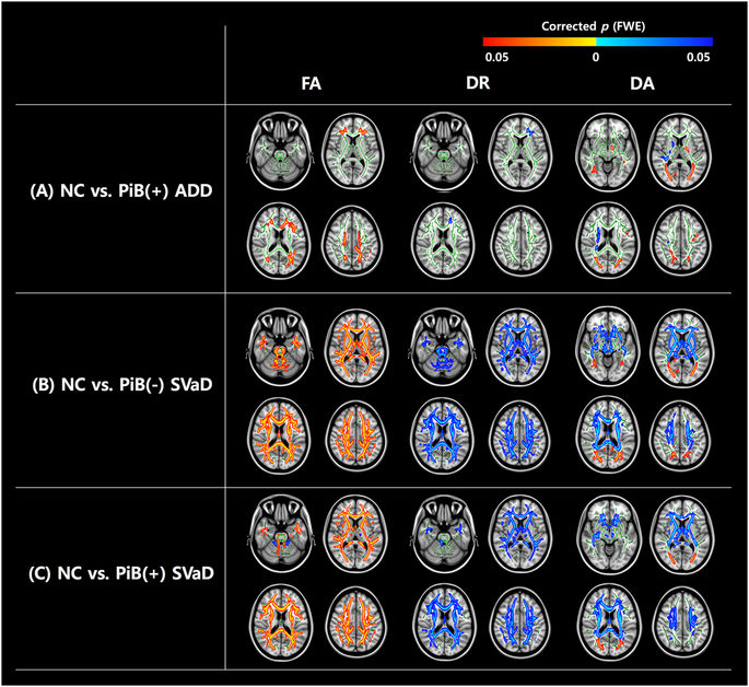Correlations between gray matter and white matter degeneration in pure