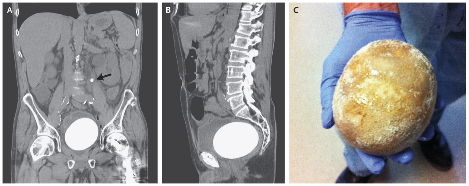 新膀胱结石,The New England Journal of Medicine XMOL