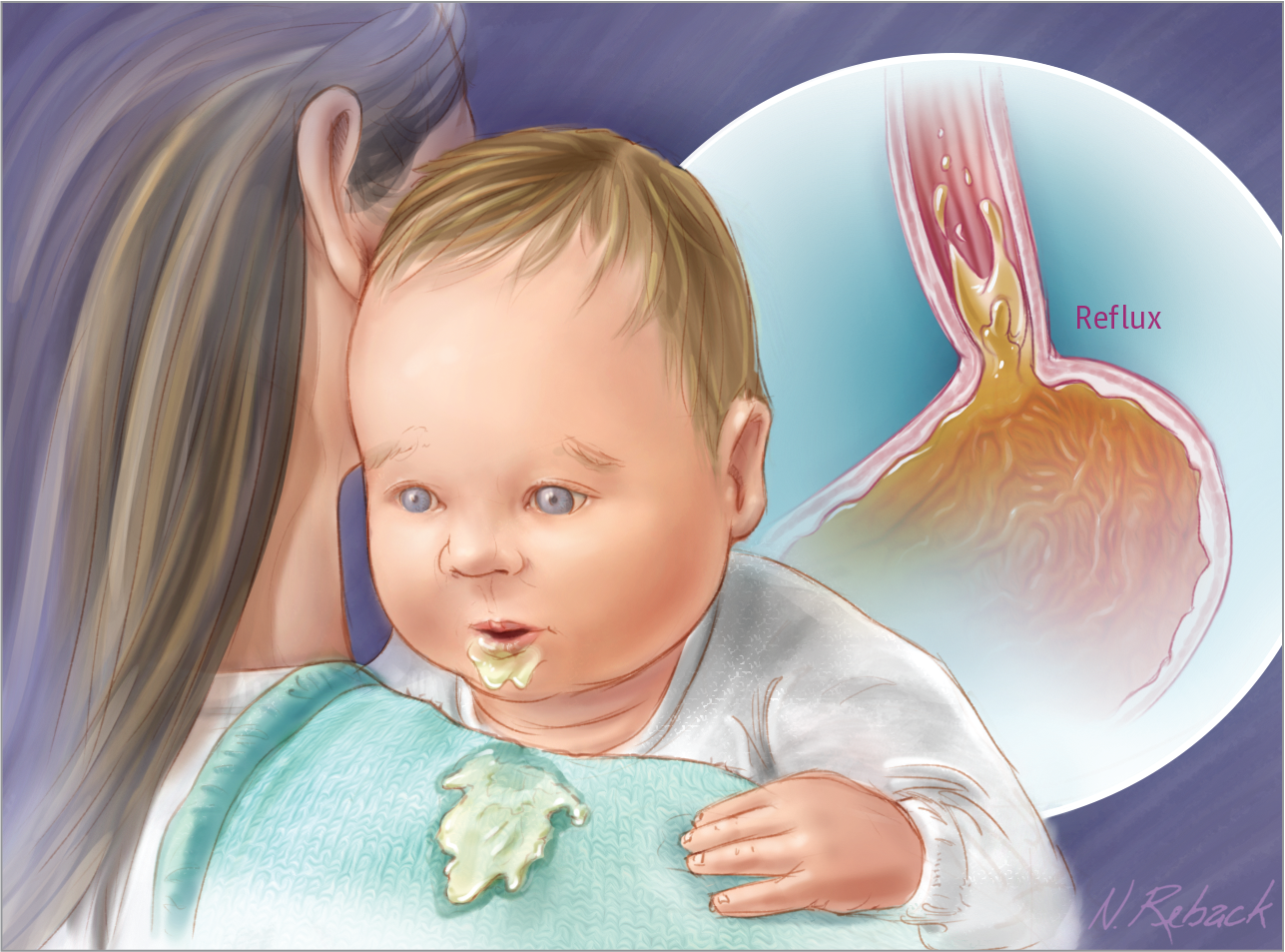 Study Questions Use of Acid Suppressors to Curb Mild Infant Reflux,JAMA