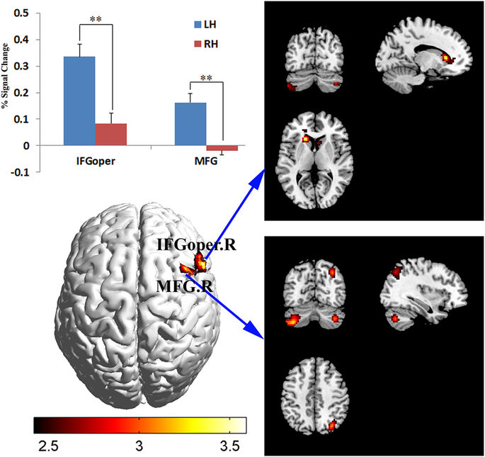 Language Processing Contralateral Language lateralization during the Chinese semantic task relates to the ...