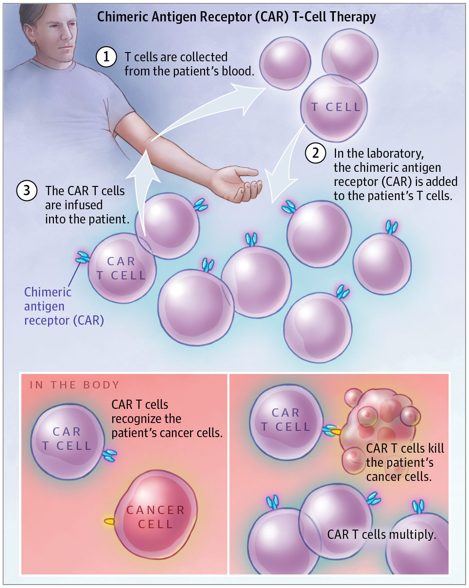 Chimeric Antigen Receptor (CAR) T-Cell Therapy,JAMA Oncology - X-MOL