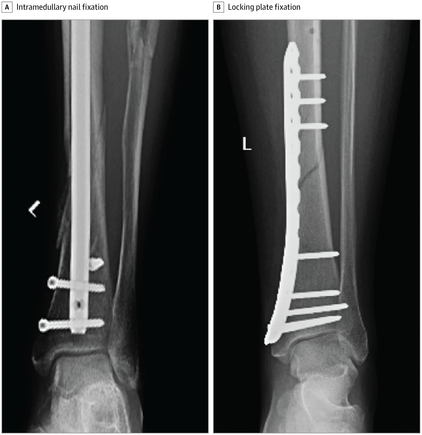 Effect Of Locking Plate Fixation Vs Intramedullary Nail Fixation On 6 effect-of-locking-plate-fixation-vs-intramedullary-nail-fixation-on-6