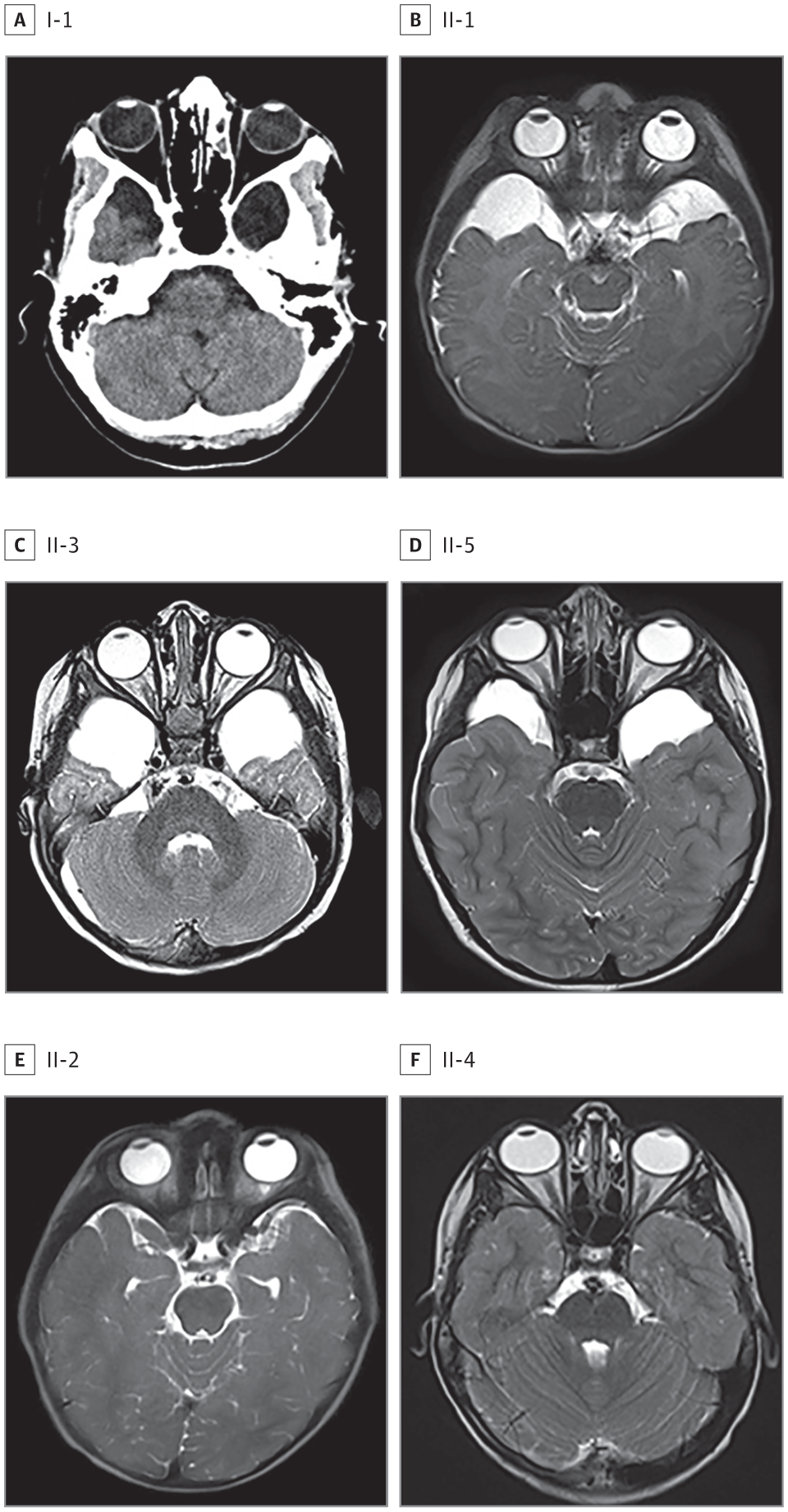 Xp222 Chromosomal Duplication In Familial Intracranial Arachnoid Cyst