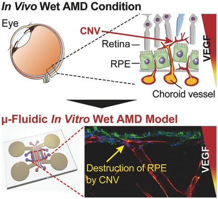 Wet Amd On A Chip Modeling Outer Blood Retinal Barrier In Vitro Advanced Healthcare Materials X Mol