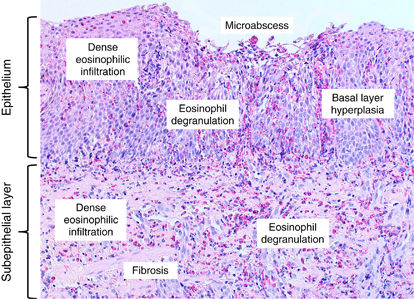 Eosinophils Histology