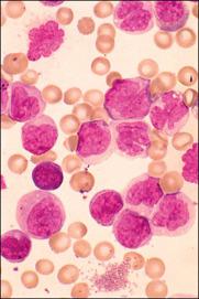 Dasatinib in paediatric chronic myeloid leukaemias,The Lancet Oncology ...