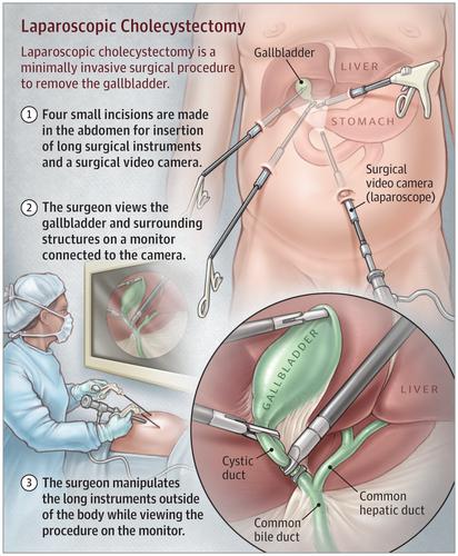 Laparoscopic Cholecystectomy For Symptomatic Cholelithiasis With Or Without Cholangiogram Websurg The E Surgical Reference Of Laparoscopic Surgery Websurg The Online University Of Ircad