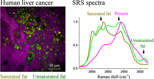 Hyperspectral Stimulated Raman Scattering Microscopy Unravels Aberrant ...