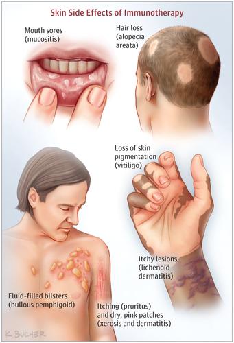 Chemotherapy Side Effects Skin