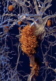阿尔茨海默氏病研究：BACE抑制剂的未来,The Lancet - X-MOL