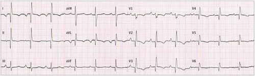 Electrocardiographic Findings In A Woman With Dextrocardia And Cyanosis Jama Internal Medicine X Mol