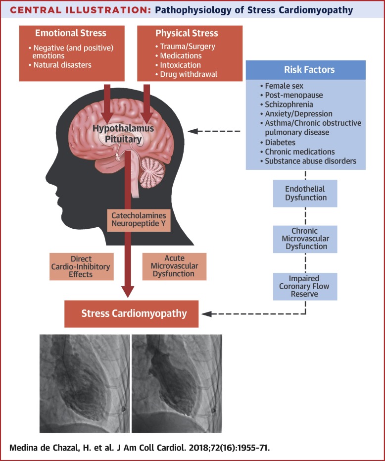 Stress Cardiomyopathy Diagnosis and Treatment,Journal of