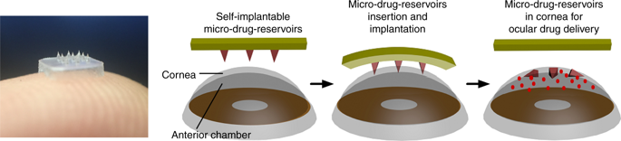 Self-implantable Double-layered Micro-drug-reservoirs For Efficient And ...