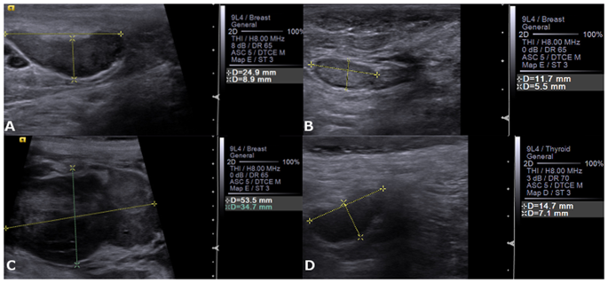 Ultrasonography For Lymph Nodes Metastasis Identification In Bitches