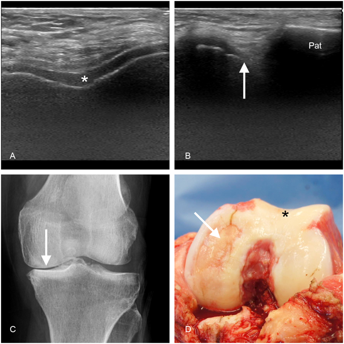 Ultrasonography Of The Late-stage Knee Osteoarthritis Prior To Total ...