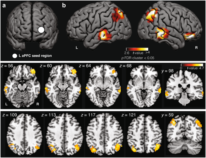 Frequent Lucid Dreaming Associated With Increased Functional Connectivity Between Frontopolar Cortex And Temporoparietal Association Areas Scientific Reports X Mol