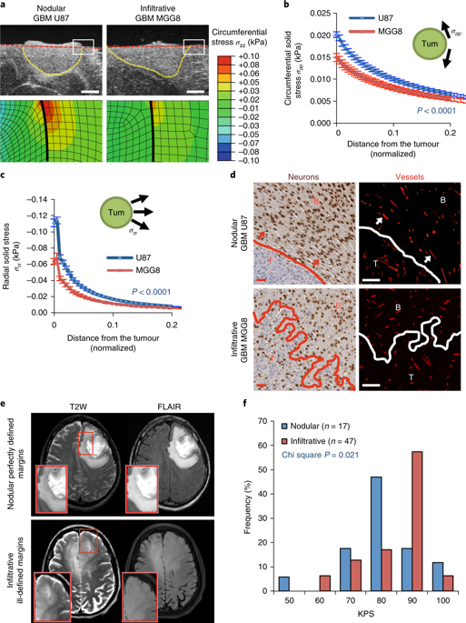 Solid Stress In Brain Tumours Causes Neuronal Loss And Neurological ...