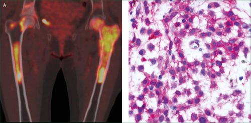 Hairy Cell Leukaemia Mimicking Multiple Myeloma The Lancet Oncology X Mol