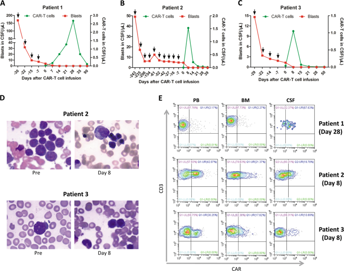 Anti-CD19 CAR-T As A Feasible And Safe Treatment Against Central ...