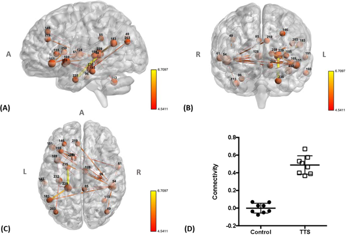 Brain Functional Connectivity Is Altered In Patients With Takotsubo Syndrome Scientific Reports X Mol