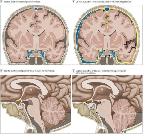 cerebrospinal fluid leak hospital