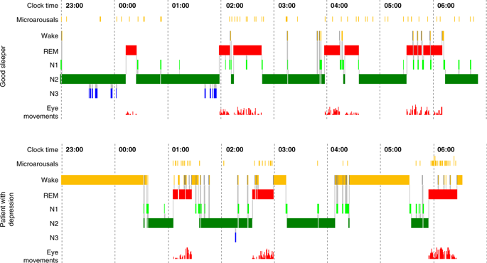 Rem sleep latency depression